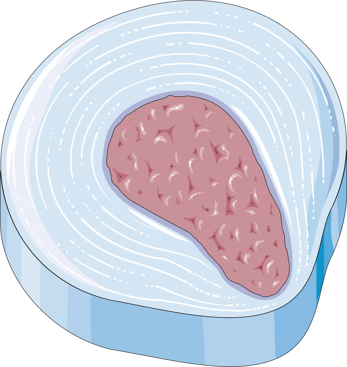 Schéma d’une protrusion discale contenue